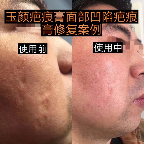 脸上痘印的祛除方法：玉颜疤痕膏是否有效？